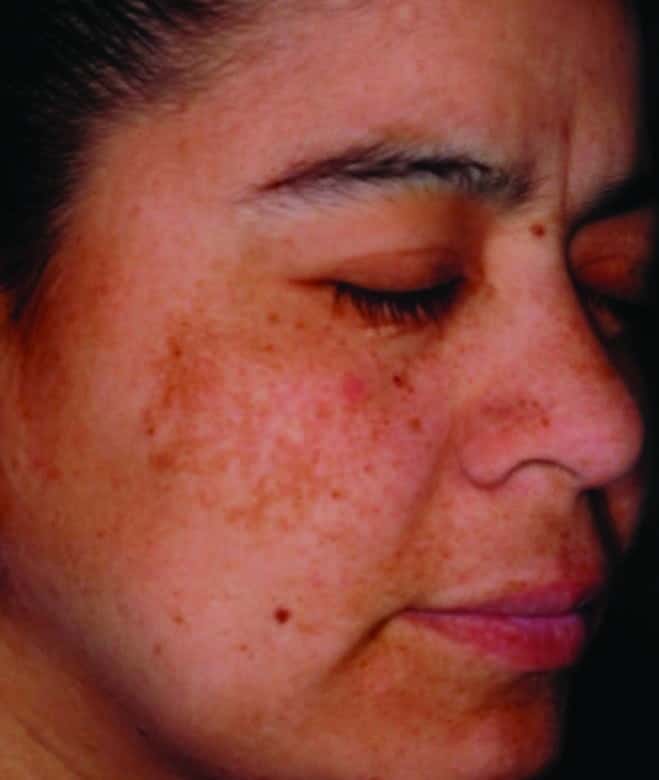 Einführung in ungleichmäßige Hyperpigmentierung (Läsionen/Flecken).