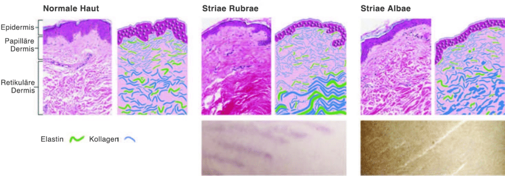 Einführung in Dehnungsstreifen, die durch eine übermäßige Dehnung der Haut verursacht werden können.